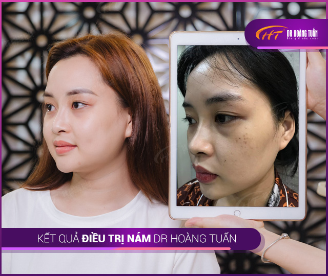 Kết quả điều trị nám tại Thẩm mỹ Hoàng Tuấn